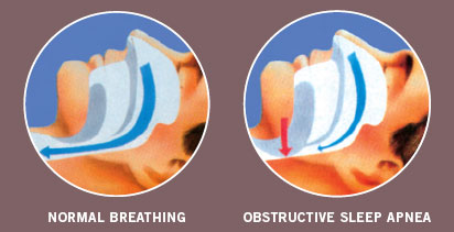 What is Obstructive Sleep Apnea?